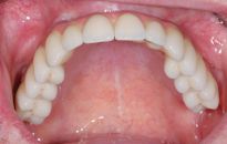 Implanty - najskuteczniejsza metoda uzupełniania braków w uzębieniu