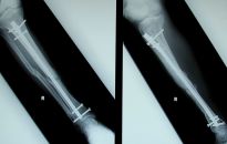 Czy wiesz, jakie urazy najczęściej grożą narciarzom i snowboardzistom? 