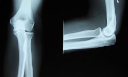 Czy wiesz, jakie urazy najczęściej grożą narciarzom i snowboardzistom? 