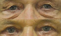 Nadmierna wiotkość skóry powiek