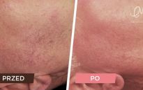 Piękna twarz i zdrowa skóra bez rozszerzonych naczynek