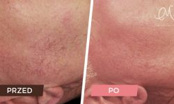 Piękna twarz i zdrowa skóra bez rozszerzonych naczynek