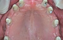 Implanty - piękny uśmiech, lepsze życie