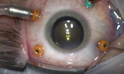 Oko hybrydowe przyszłością światowej okulistyki